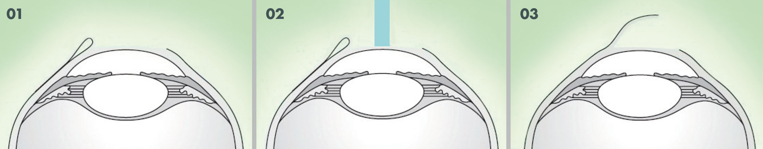 Lasik Behandlungsschritte